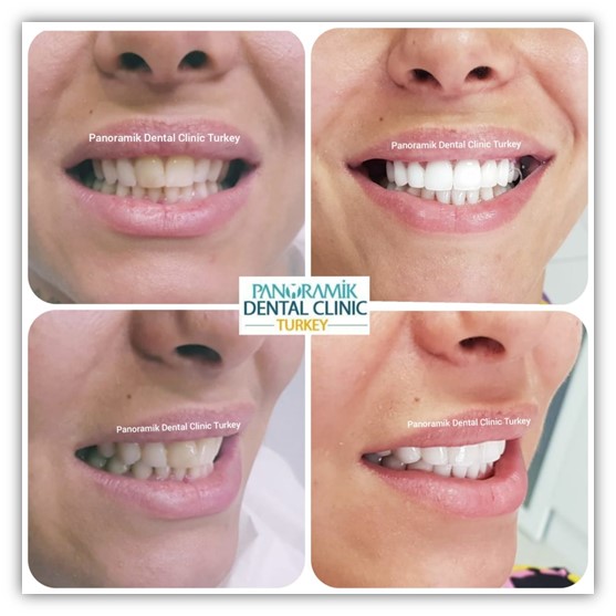 Hollywood Gülüşü Antalya | Gülüş Tasarımı Nasıl Yapılır?