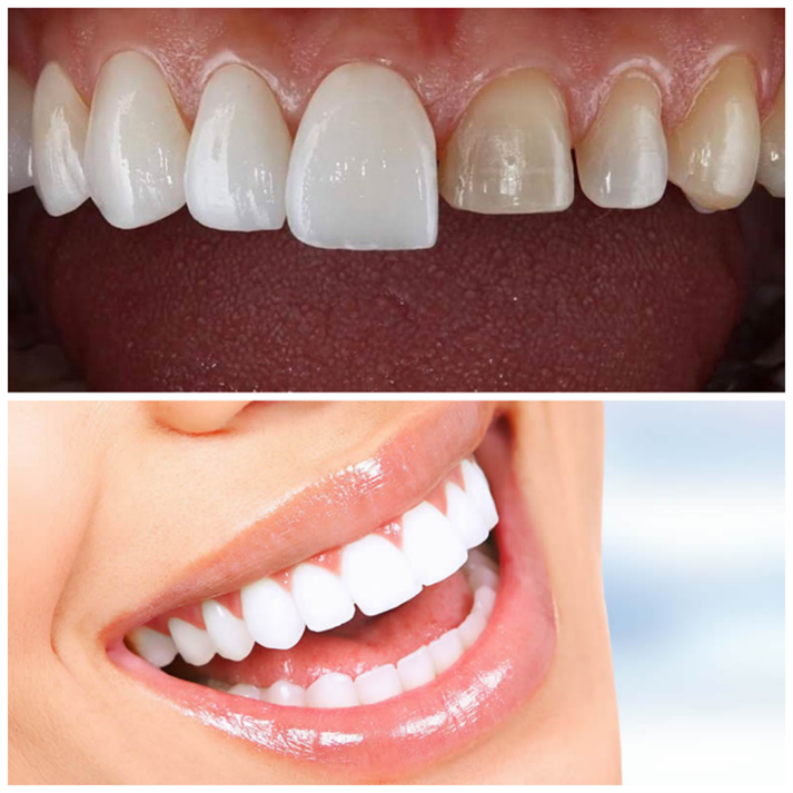 Zirkonyum Diş Kaplama Fiyatları Antalya